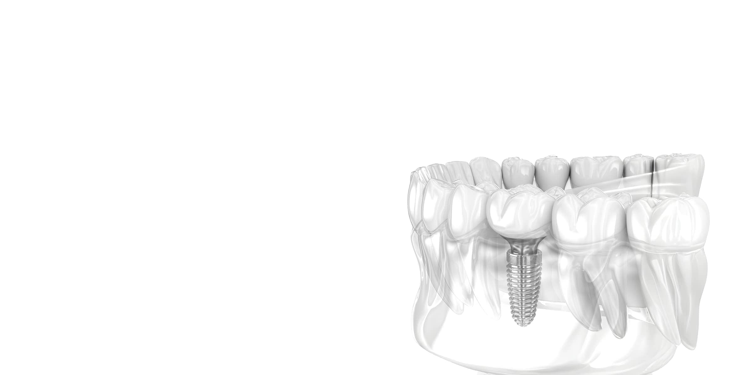 Зъбни Импланти: Инвестиция в Трайно Здраве и Естетика