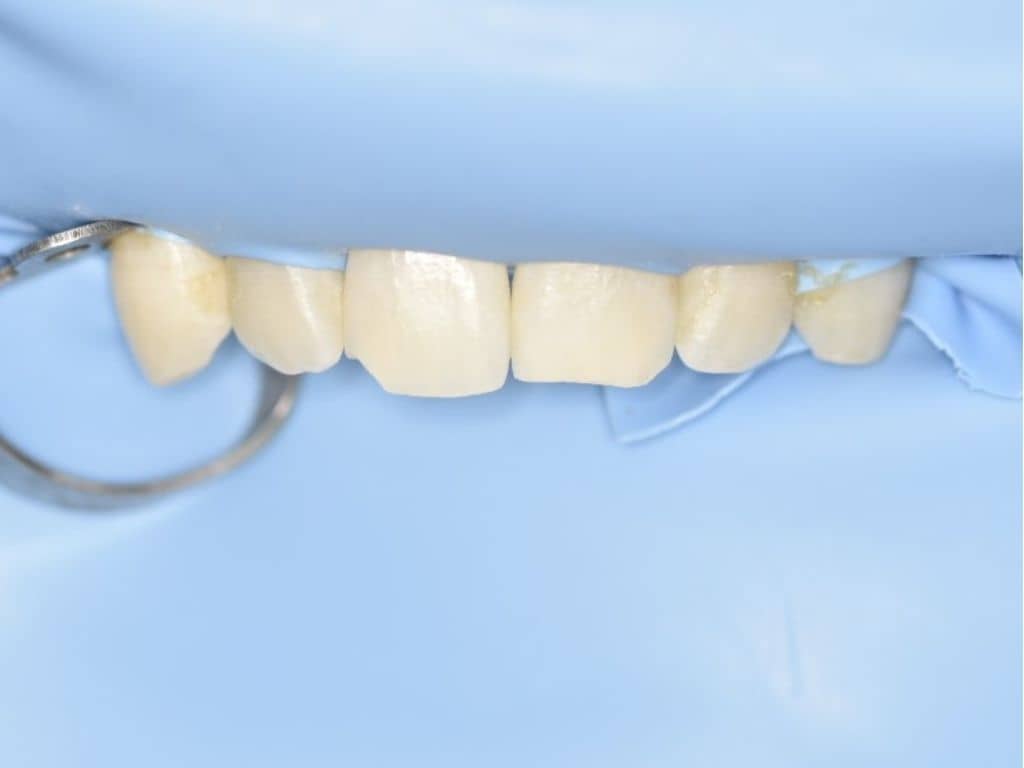 Преди лечение