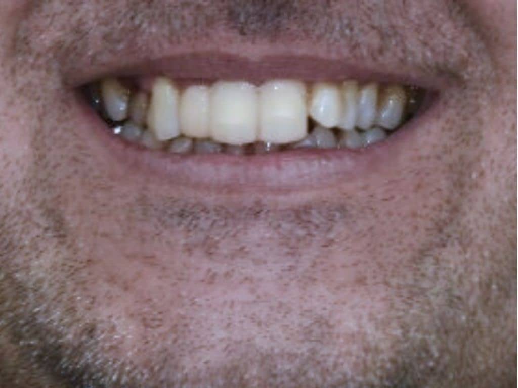 След лечение