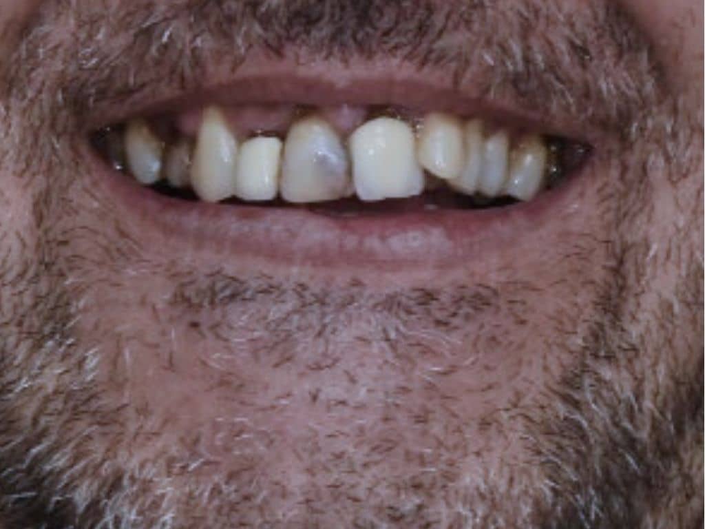 Преди лечение