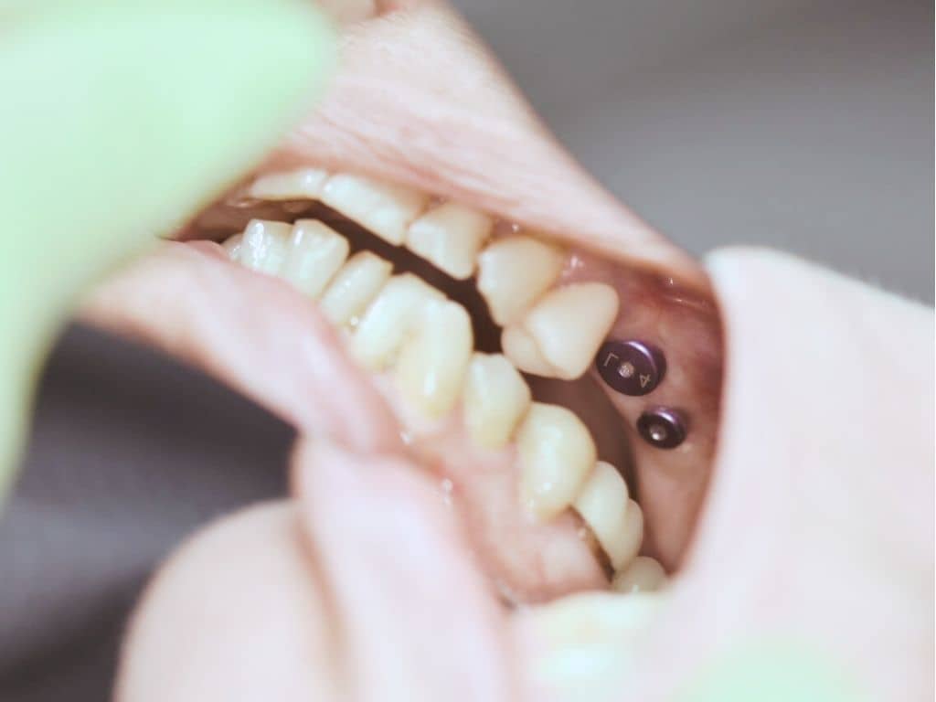 Имплантология - снимка 1