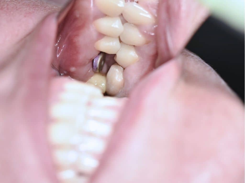 Имплантология - снимка 2