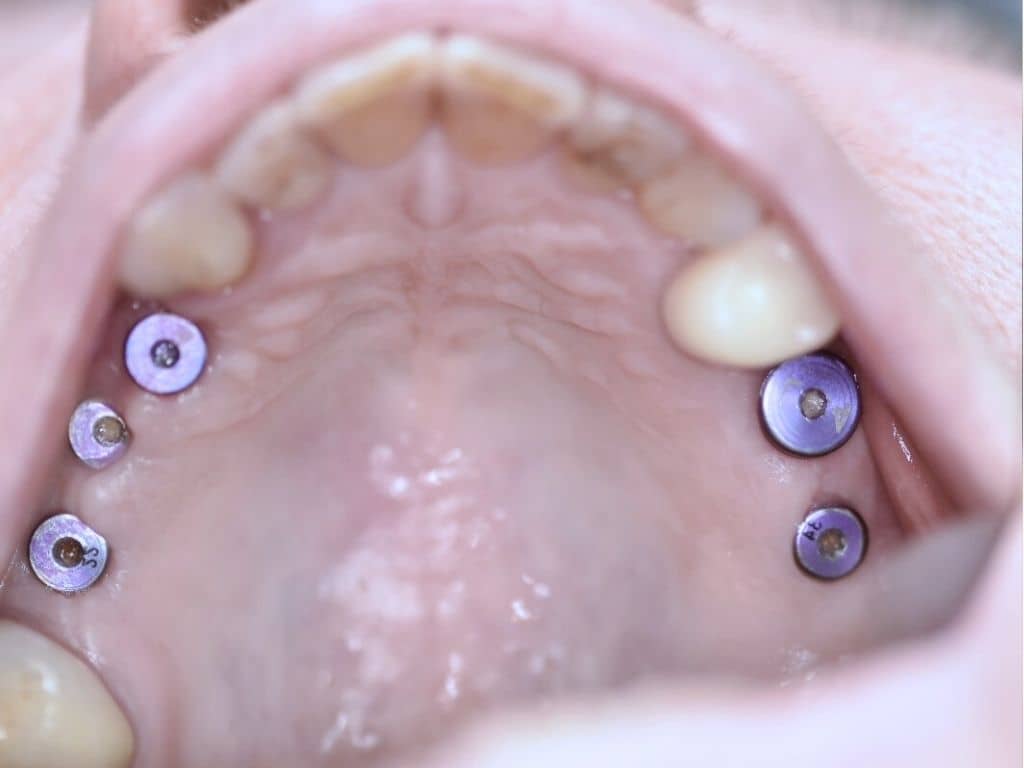 Имплантология - снимка 3