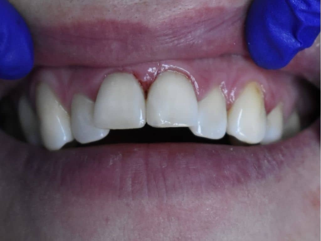 След лечение