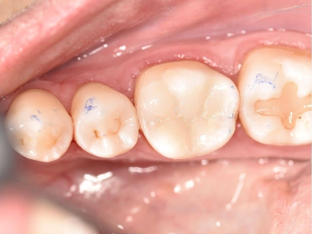 След лечение