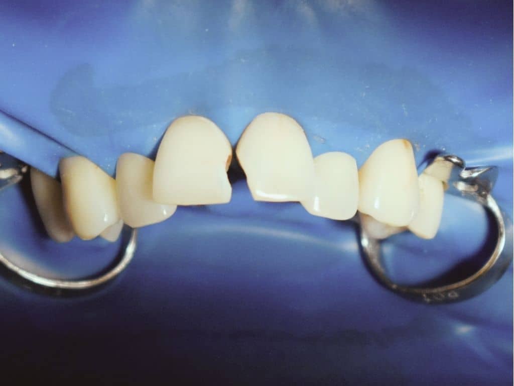 Преди лечение