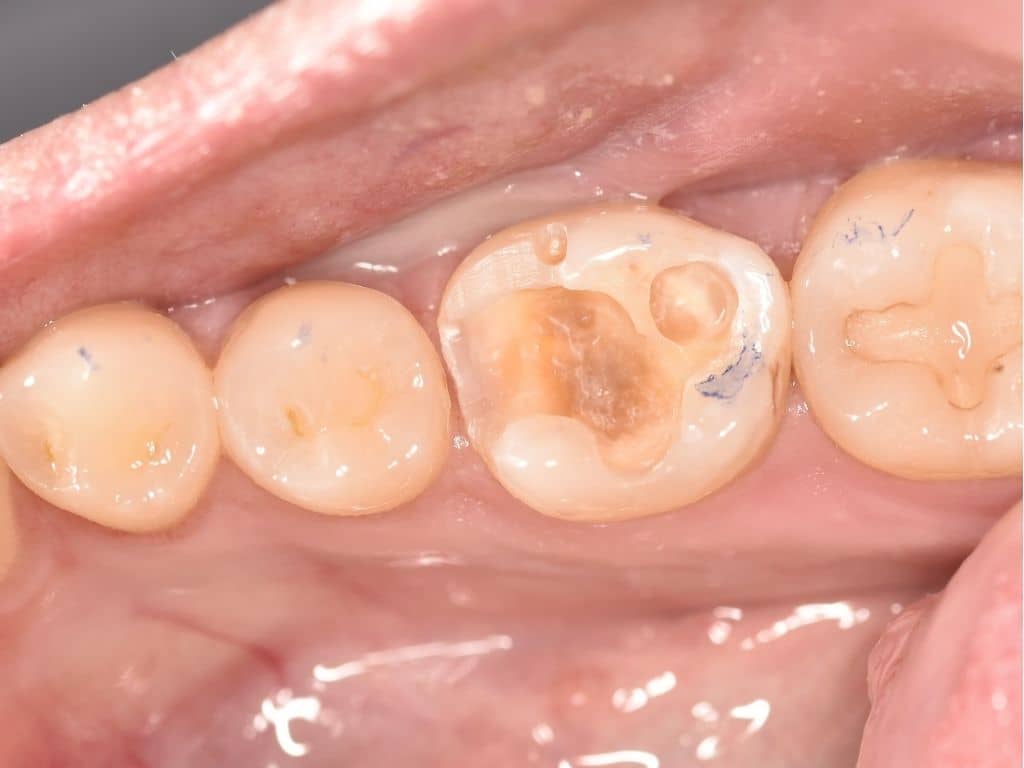 Преди лечение